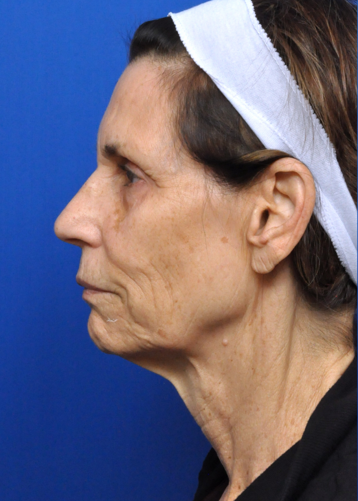 Plastic Surgery Before and After Pictures in Jacksonville, FL - Garcia Facial Plastic Surgery