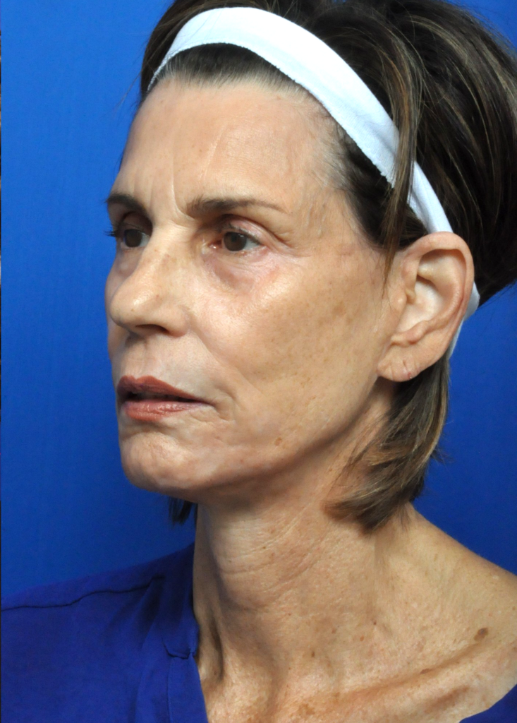 Plastic Surgery Before and After Pictures in Jacksonville, FL - Garcia Facial Plastic Surgery