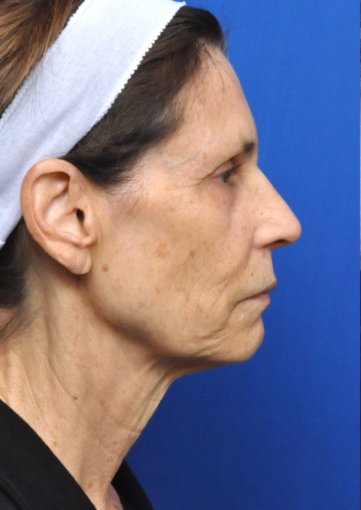 Plastic Surgery Before and After Pictures in Jacksonville, FL - Garcia Facial Plastic Surgery