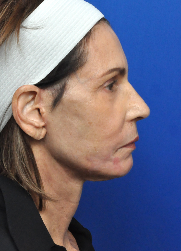 Plastic Surgery Before and After Pictures in Jacksonville, FL - Garcia Facial Plastic Surgery