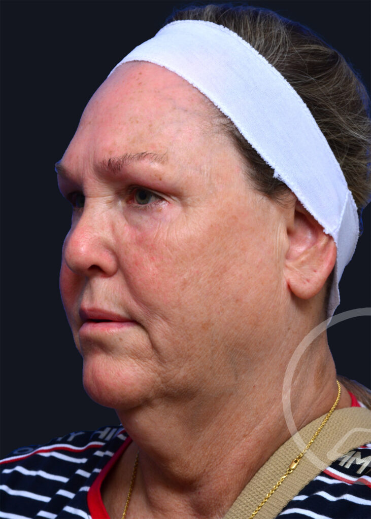 Plastic Surgery Before and After Pictures in Jacksonville, FL - Garcia Facial Plastic Surgery