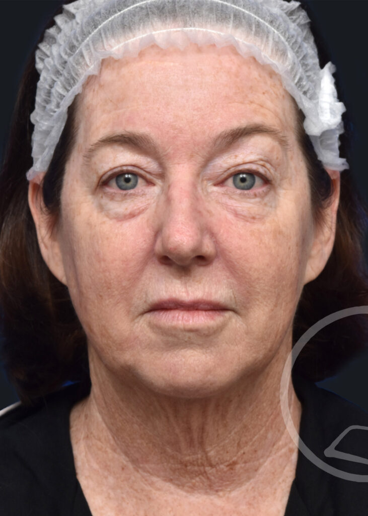 Plastic Surgery Before and After Pictures in Jacksonville, FL - Garcia Facial Plastic Surgery