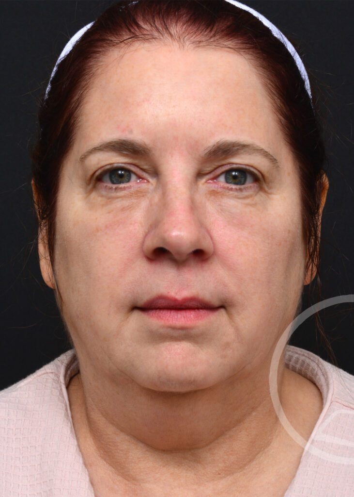 Plastic Surgery Before and After Pictures in Jacksonville, FL - Garcia Facial Plastic Surgery