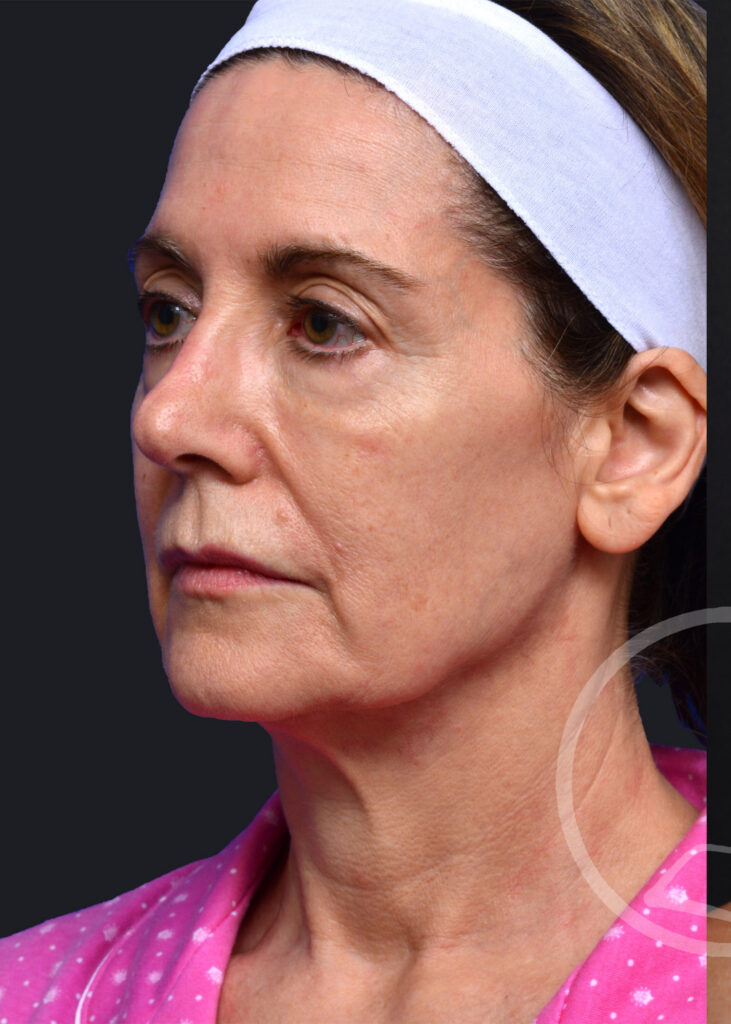 Plastic Surgery Before and After Pictures in Jacksonville, FL - Garcia Facial Plastic Surgery