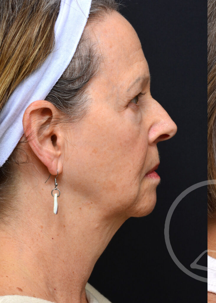 Plastic Surgery Before and After Pictures in Jacksonville, FL - Garcia Facial Plastic Surgery