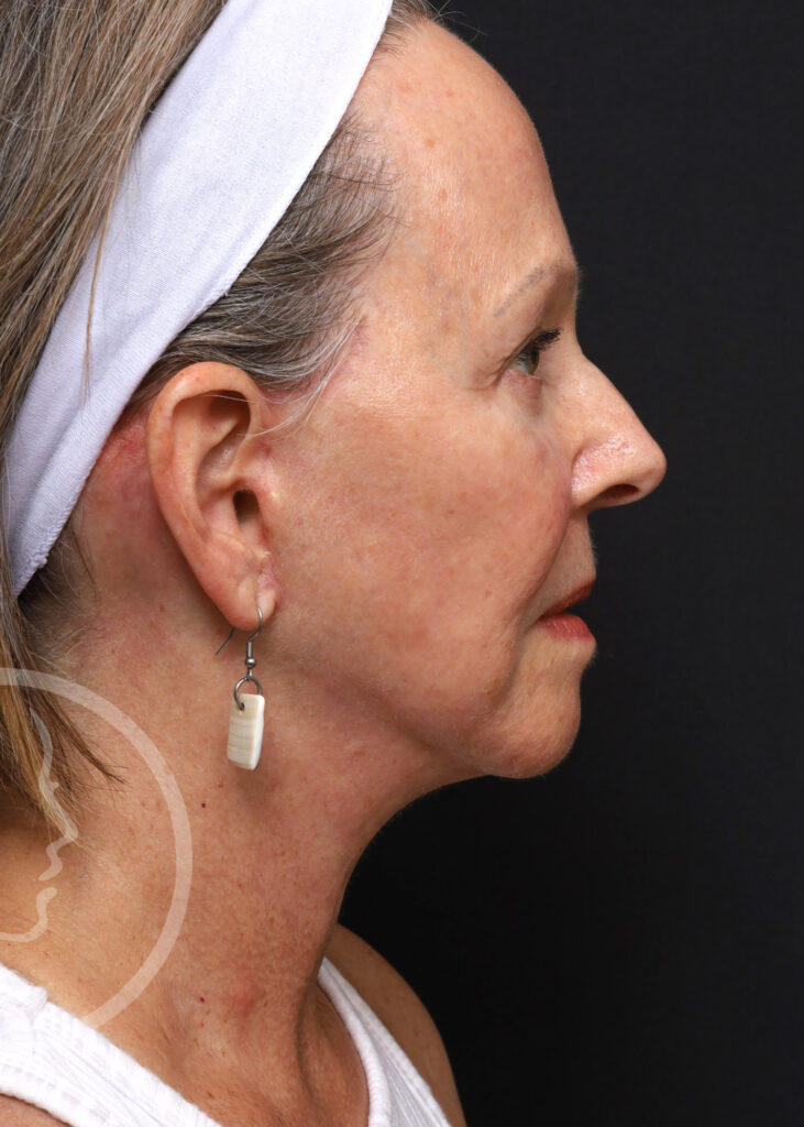 Plastic Surgery Before and After Pictures in Jacksonville, FL - Garcia Facial Plastic Surgery