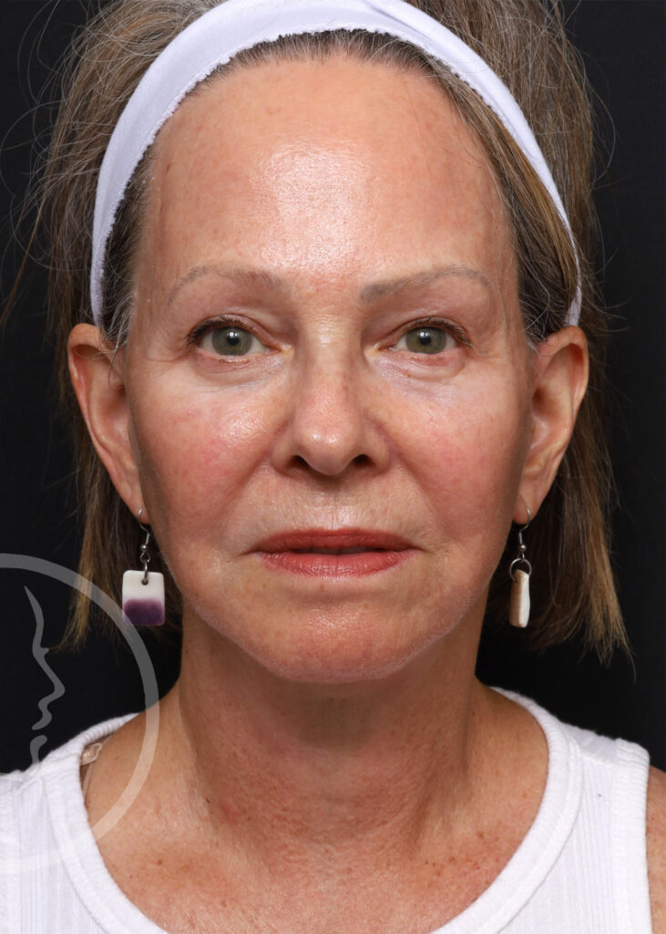 Plastic Surgery Before and After Pictures in Jacksonville, FL - Garcia Facial Plastic Surgery