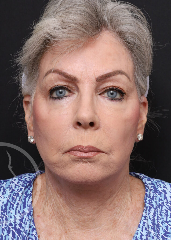 Plastic Surgery Before and After Pictures in Jacksonville, FL - Garcia Facial Plastic Surgery