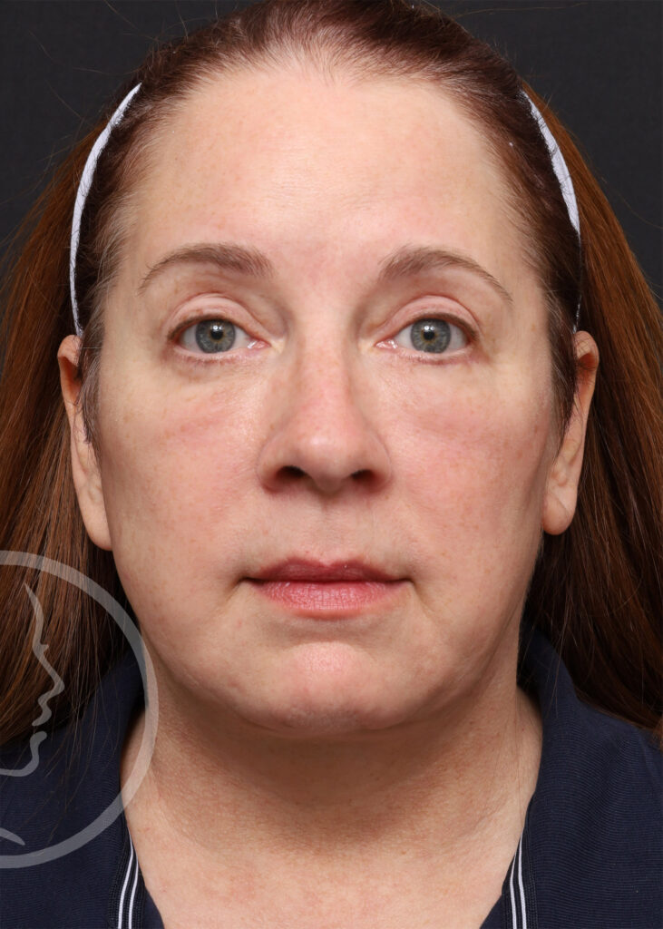 Plastic Surgery Before and After Pictures in Jacksonville, FL - Garcia Facial Plastic Surgery