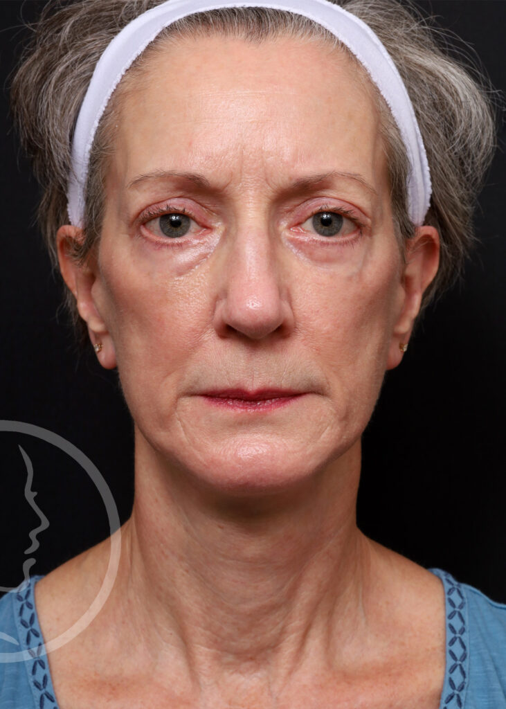 Plastic Surgery Before and After Pictures in Jacksonville, FL - Garcia Facial Plastic Surgery