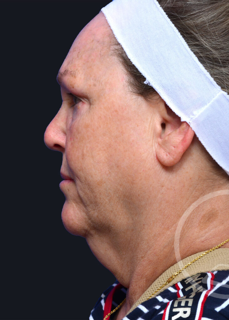 Plastic Surgery Before and After Pictures in Jacksonville, FL - Garcia Facial Plastic Surgery