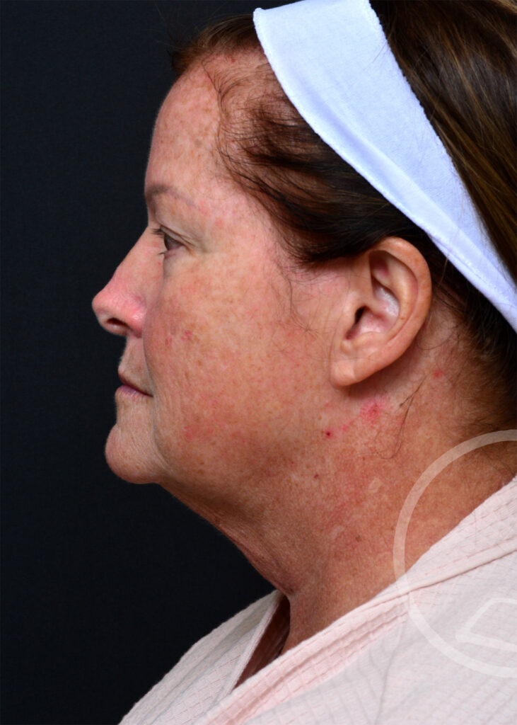 Plastic Surgery Before and After Pictures in Jacksonville, FL - Garcia Facial Plastic Surgery