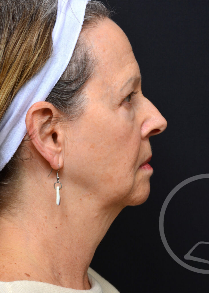 Plastic Surgery Before and After Pictures in Jacksonville, FL - Garcia Facial Plastic Surgery