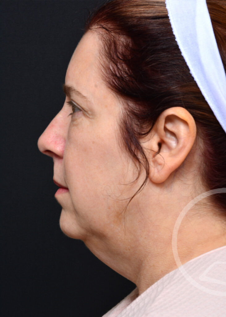 Plastic Surgery Before and After Pictures in Jacksonville, FL - Garcia Facial Plastic Surgery