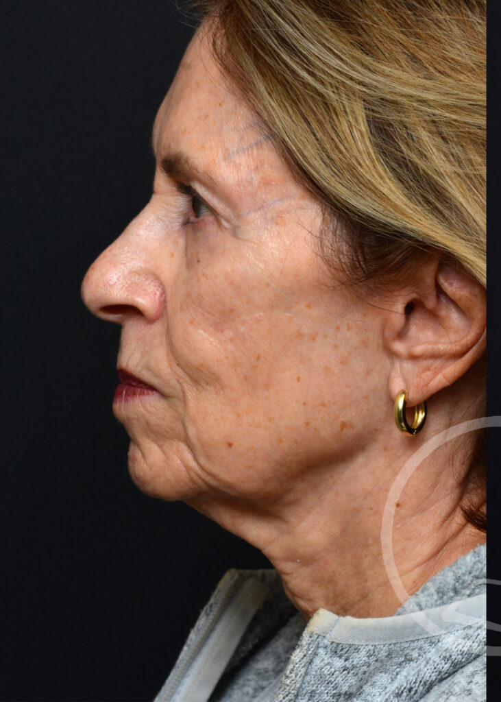 Plastic Surgery Before and After Pictures in Jacksonville, FL - Garcia Facial Plastic Surgery