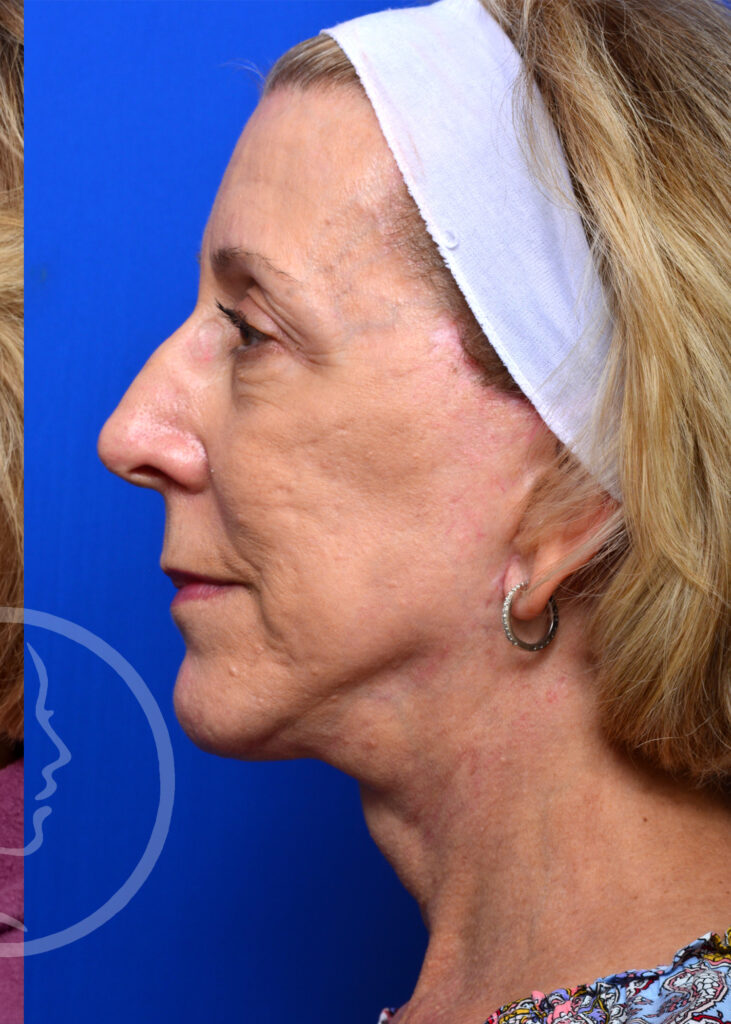 Plastic Surgery Before and After Pictures in Jacksonville, FL - Garcia Facial Plastic Surgery