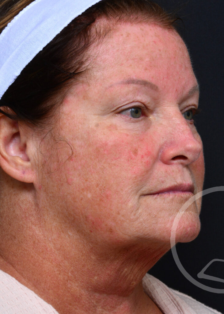 Plastic Surgery Before and After Pictures in Jacksonville, FL - Garcia Facial Plastic Surgery