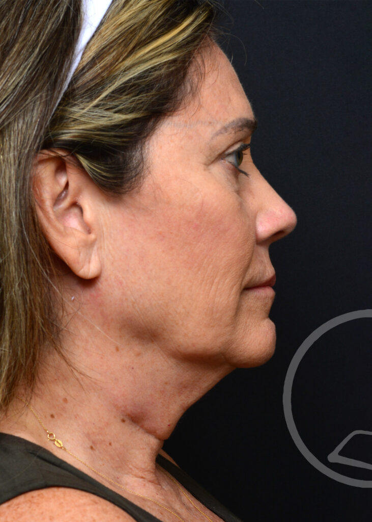 Plastic Surgery Before and After Pictures in Jacksonville, FL - Garcia Facial Plastic Surgery