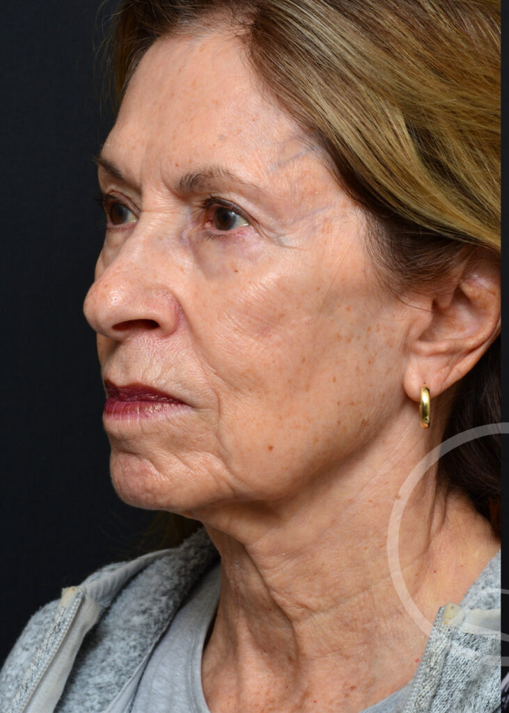 Plastic Surgery Before and After Pictures in Jacksonville, FL - Garcia Facial Plastic Surgery