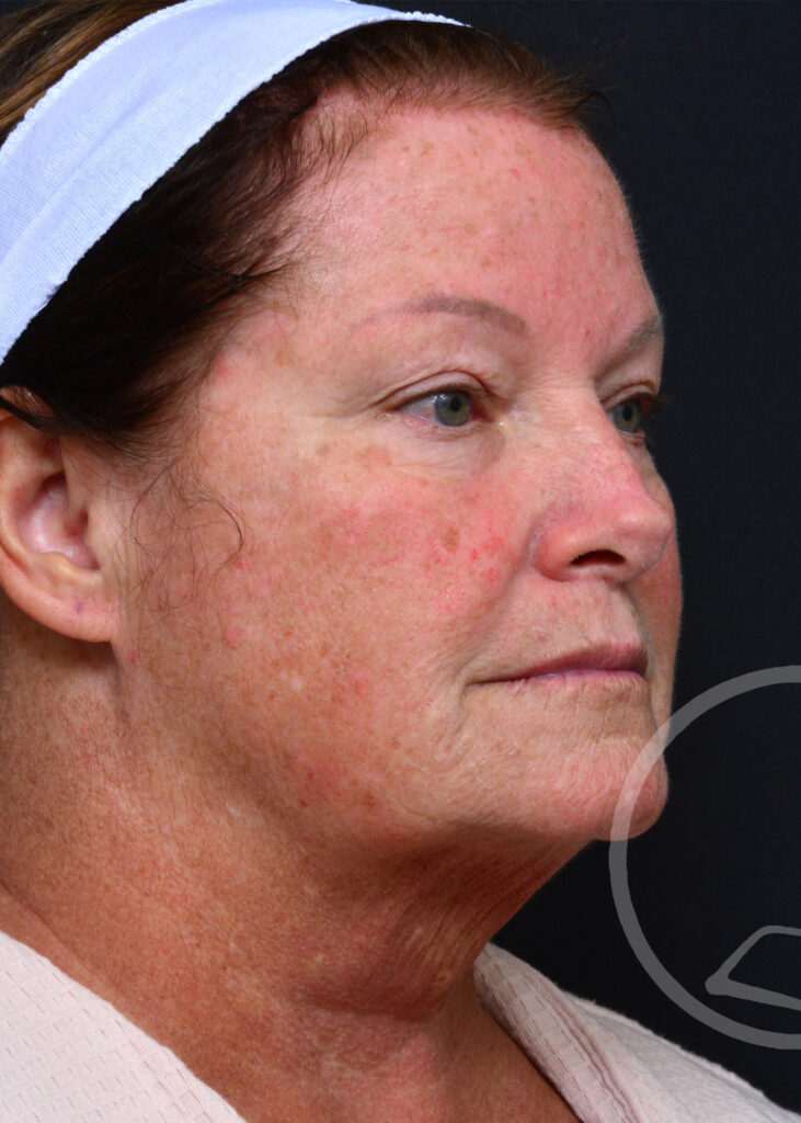 Plastic Surgery Before and After Pictures in Jacksonville, FL - Garcia Facial Plastic Surgery