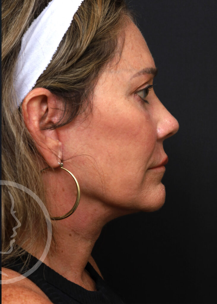 Plastic Surgery Before and After Pictures in Jacksonville, FL - Garcia Facial Plastic Surgery