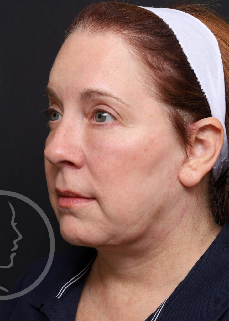 Plastic Surgery Before and After Pictures in Jacksonville, FL - Garcia Facial Plastic Surgery