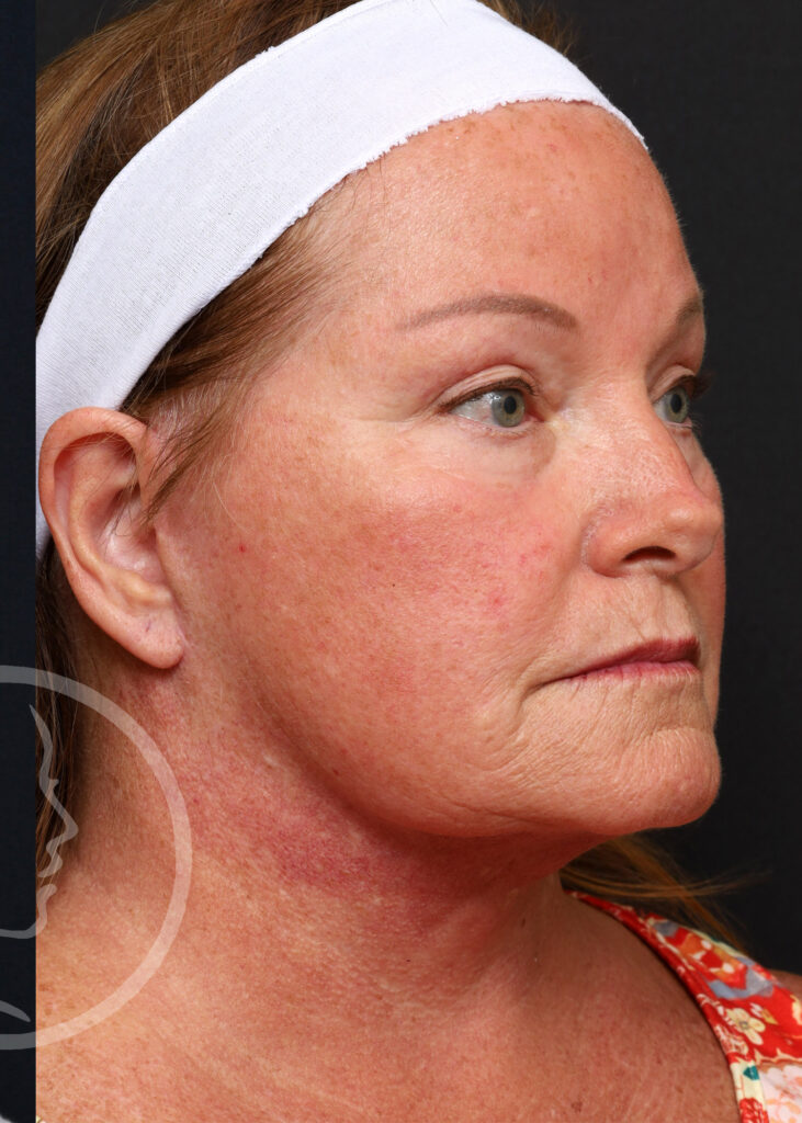 Plastic Surgery Before and After Pictures in Jacksonville, FL - Garcia Facial Plastic Surgery