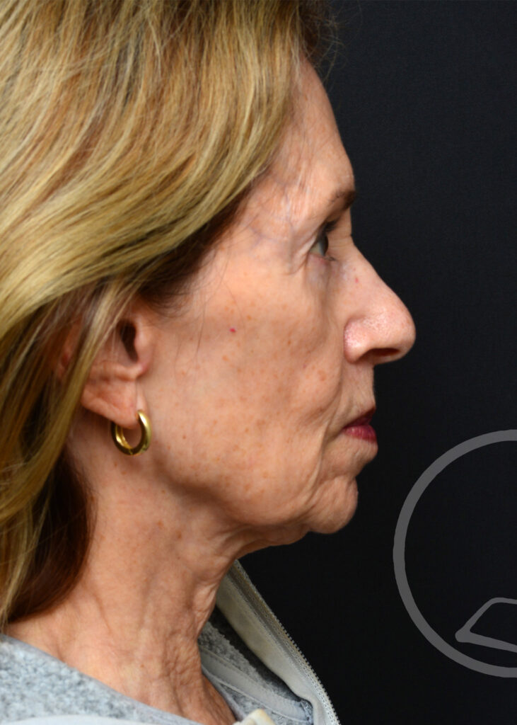 Plastic Surgery Before and After Pictures in Jacksonville, FL - Garcia Facial Plastic Surgery