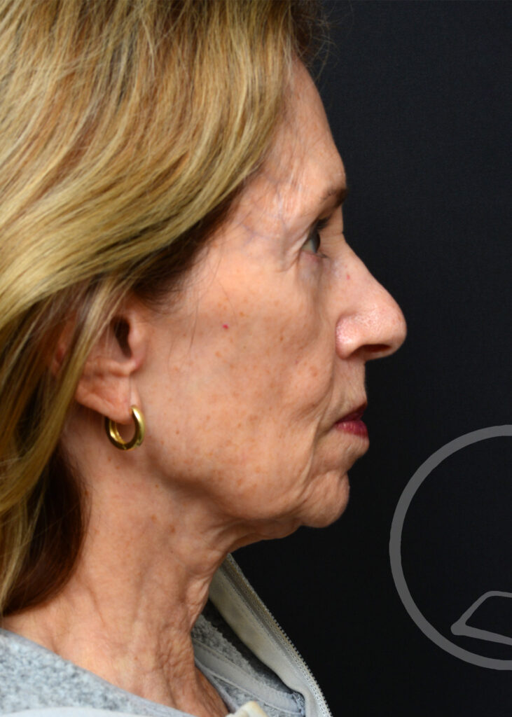 Plastic Surgery Before and After Pictures in Jacksonville, FL - Garcia Facial Plastic Surgery