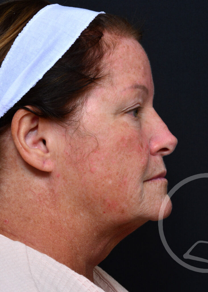 Plastic Surgery Before and After Pictures in Jacksonville, FL - Garcia Facial Plastic Surgery