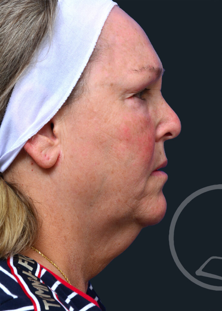 Plastic Surgery Before and After Pictures in Jacksonville, FL - Garcia Facial Plastic Surgery