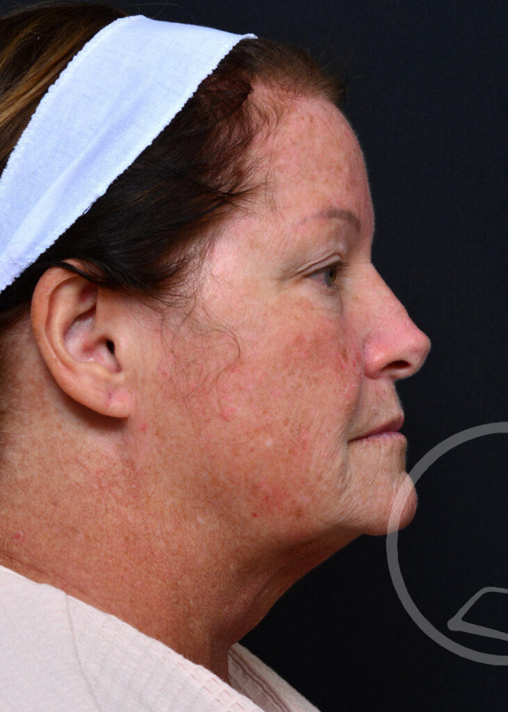 Plastic Surgery Before and After Pictures in Jacksonville, FL - Garcia Facial Plastic Surgery