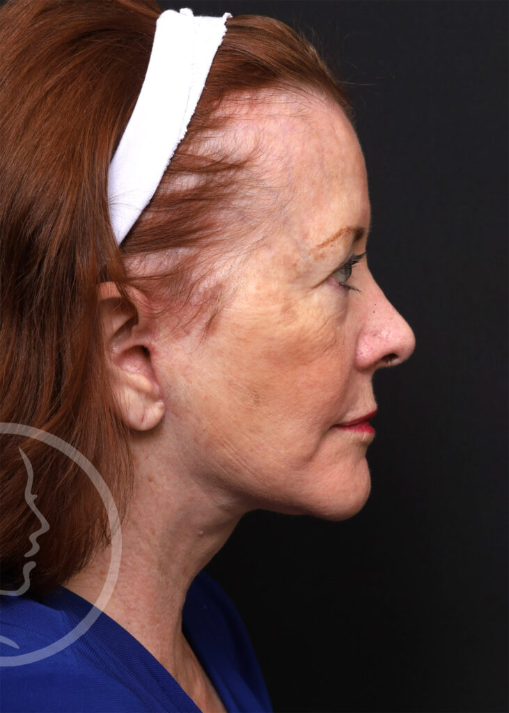 Plastic Surgery Before and After Pictures in Jacksonville, FL - Garcia Facial Plastic Surgery