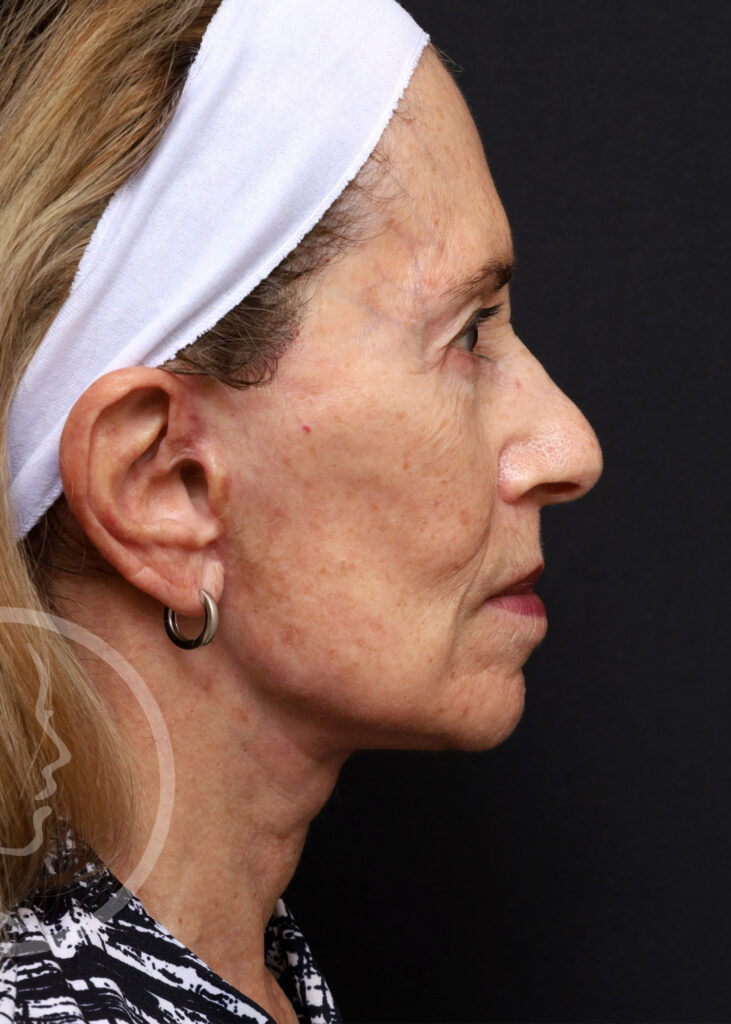 Plastic Surgery Before and After Pictures in Jacksonville, FL - Garcia Facial Plastic Surgery