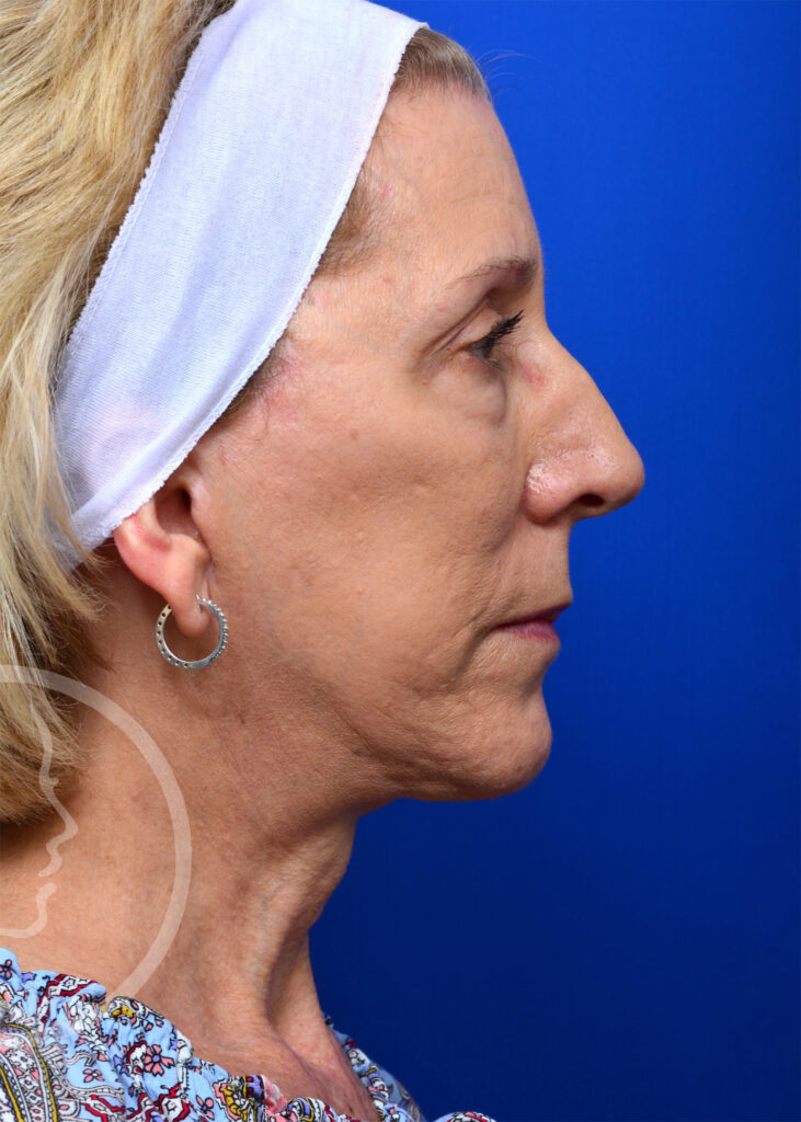 Plastic Surgery Before and After Pictures in Jacksonville, FL - Garcia Facial Plastic Surgery