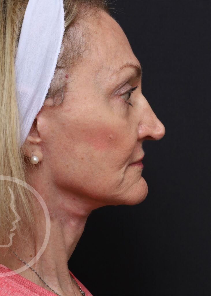 Plastic Surgery Before and After Pictures in Jacksonville, FL - Garcia Facial Plastic Surgery