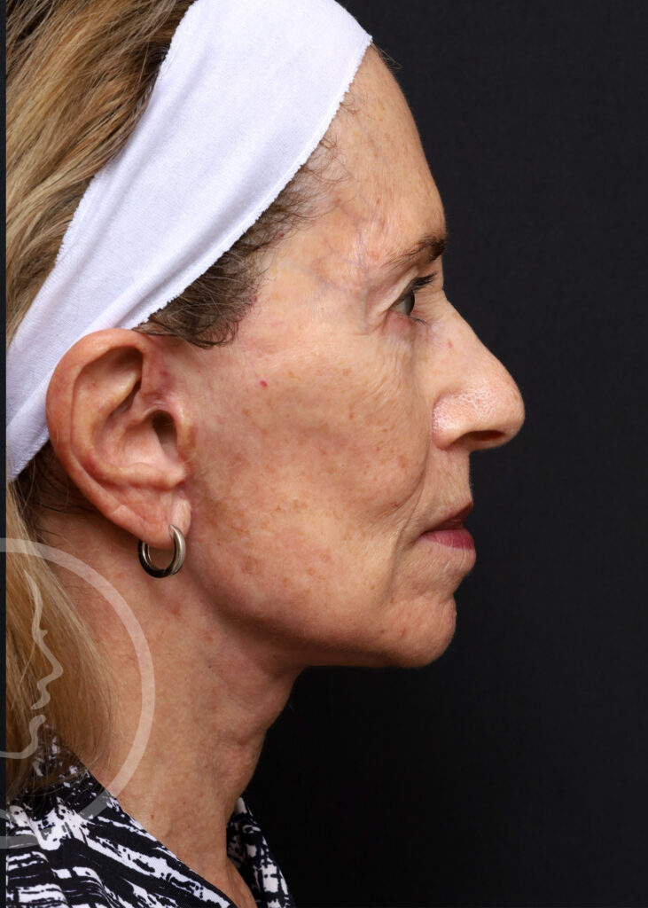 Plastic Surgery Before and After Pictures in Jacksonville, FL - Garcia Facial Plastic Surgery