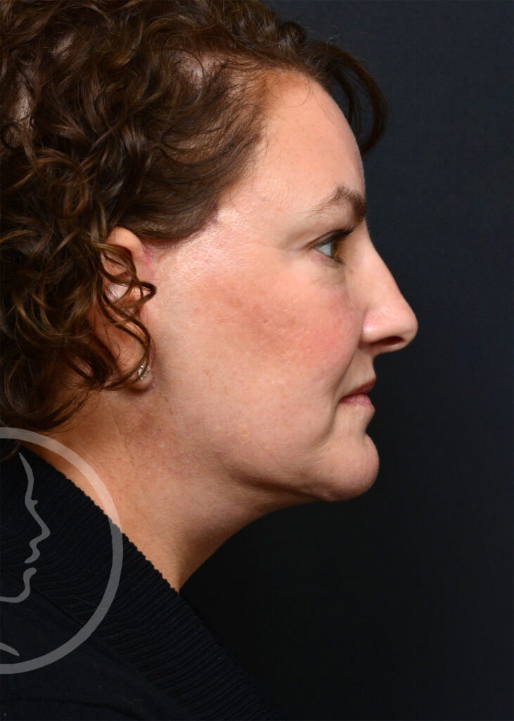 Plastic Surgery Before and After Pictures in Jacksonville, FL - Garcia Facial Plastic Surgery