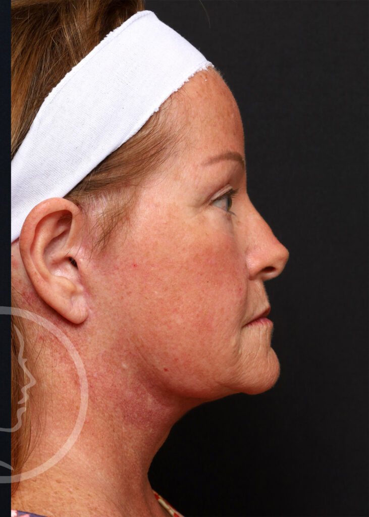 Plastic Surgery Before and After Pictures in Jacksonville, FL - Garcia Facial Plastic Surgery