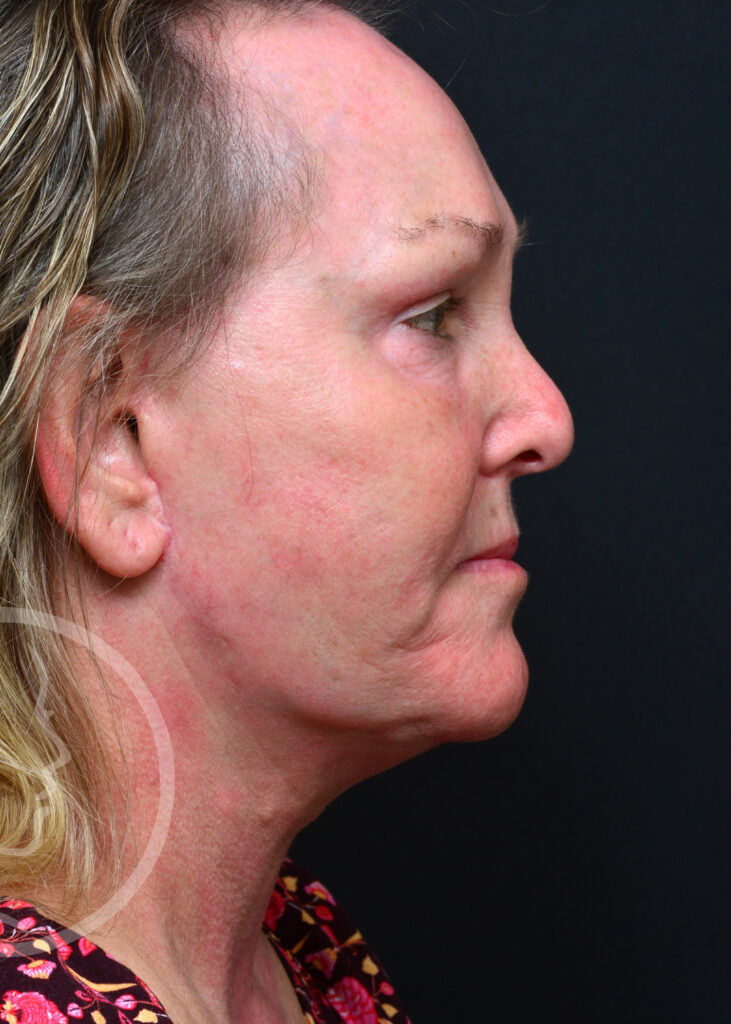 Plastic Surgery Before and After Pictures in Jacksonville, FL - Garcia Facial Plastic Surgery