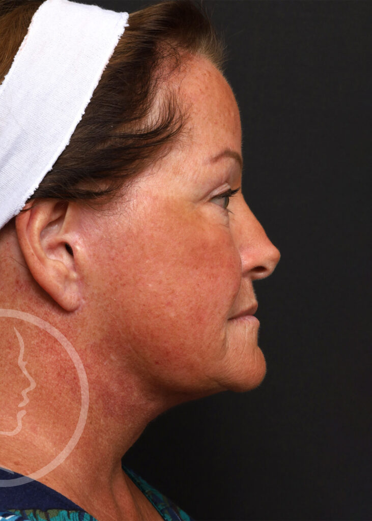 Plastic Surgery Before and After Pictures in Jacksonville, FL - Garcia Facial Plastic Surgery