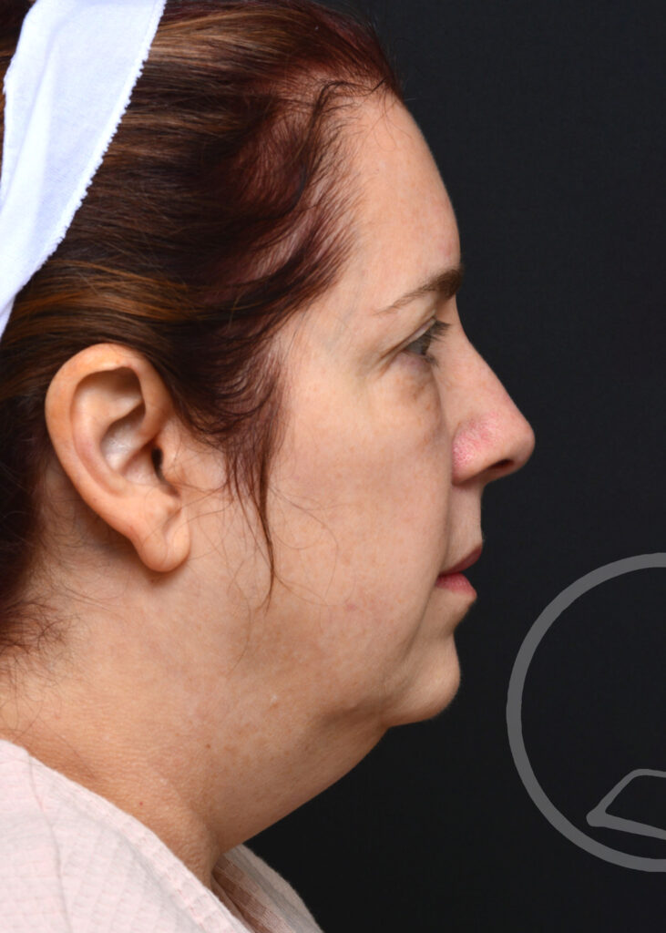 Plastic Surgery Before and After Pictures in Jacksonville, FL - Garcia Facial Plastic Surgery