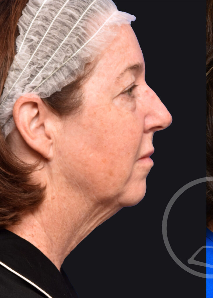 Plastic Surgery Before and After Pictures in Jacksonville, FL - Garcia Facial Plastic Surgery