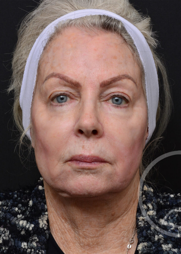 Plastic Surgery Before and After Pictures in Jacksonville, FL - Garcia Facial Plastic Surgery