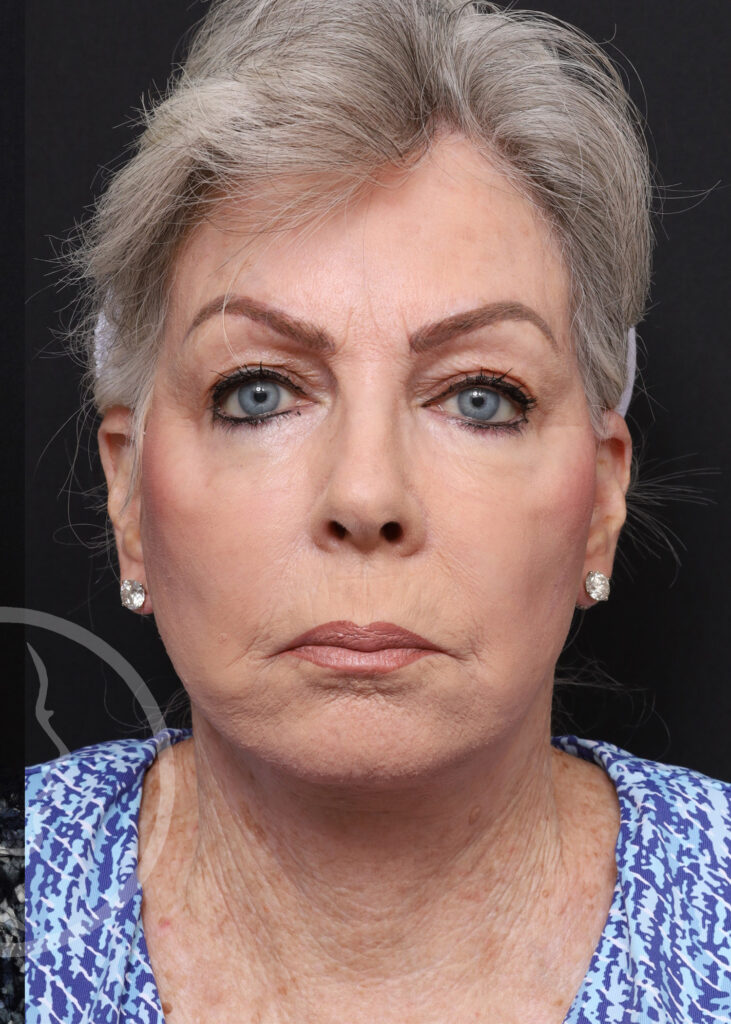 Plastic Surgery Before and After Pictures in Jacksonville, FL - Garcia Facial Plastic Surgery