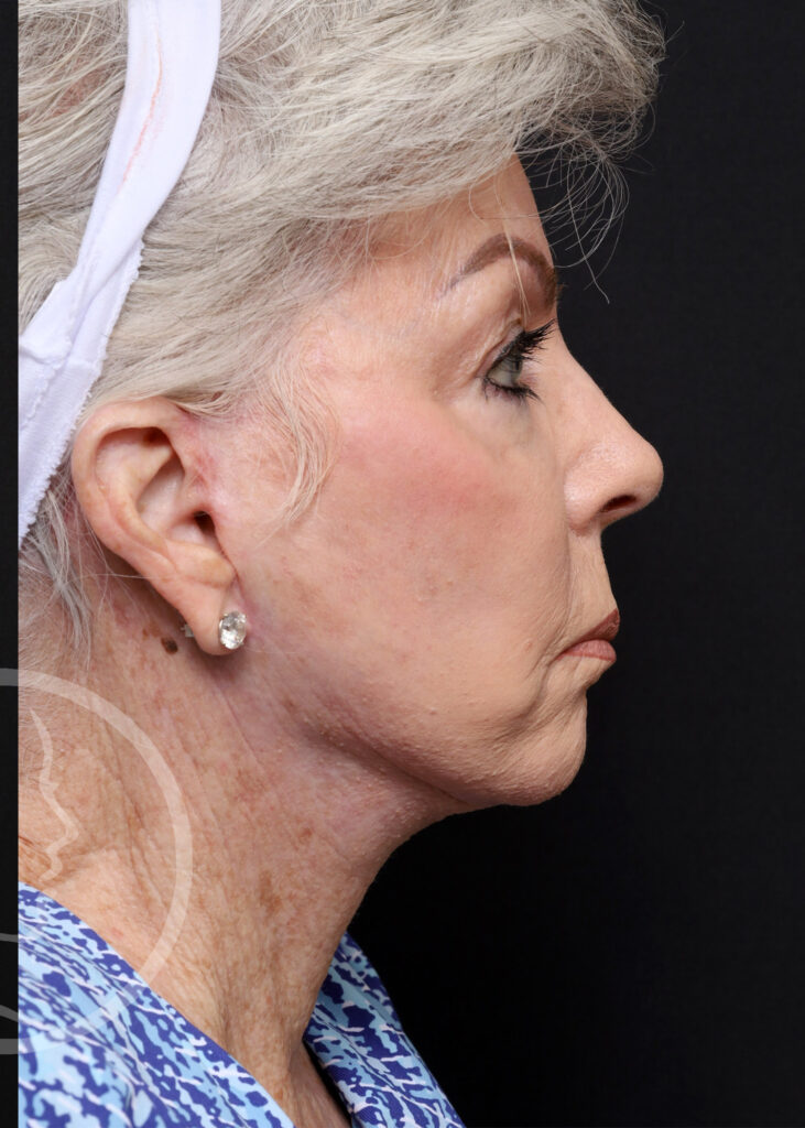 Plastic Surgery Before and After Pictures in Jacksonville, FL - Garcia Facial Plastic Surgery